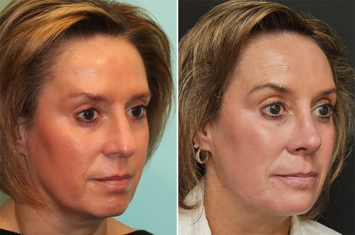 Before and after Rhinoplasty by Dr. Shervin Naderi, Patient 36851