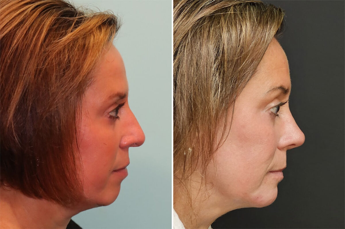 Before and after Rhinoplasty by Dr. Shervin Naderi, Patient 36851