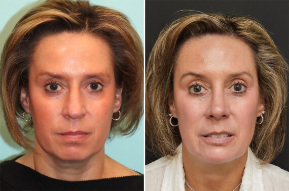 Before and after Rhinoplasty by Dr. Shervin Naderi, Patient 36851