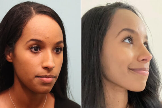 Before and after Rhinoplasty by Dr. Shervin Naderi, Patient 36857