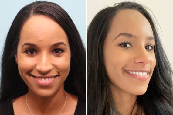 Before and after Rhinoplasty by Dr. Shervin Naderi, Patient 36857