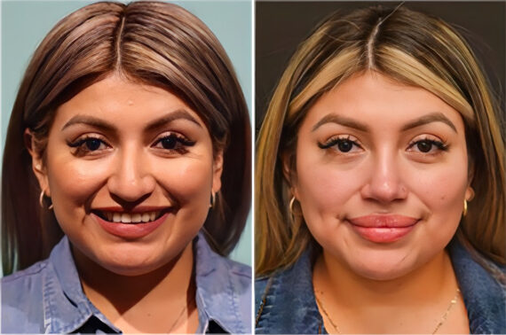 Before and after Rhinoplasty by Dr. Shervin Naderi, Patient 36861