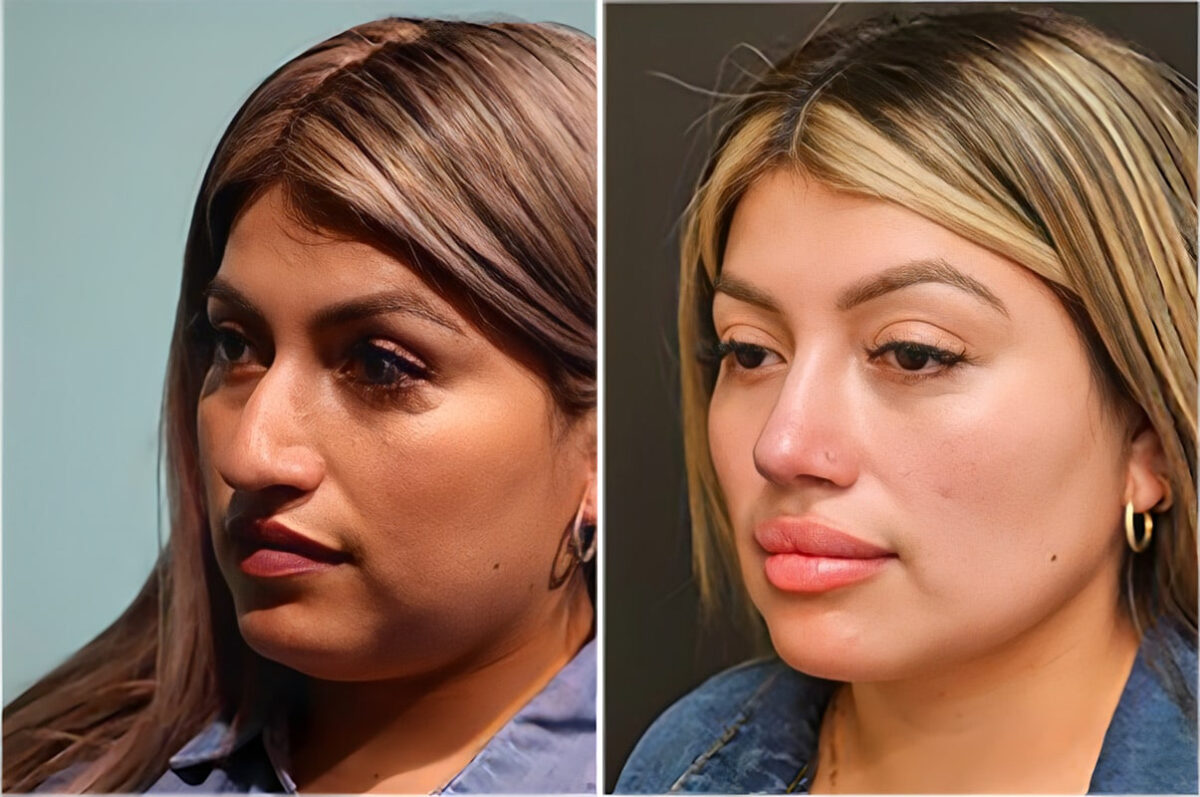 Before and after Rhinoplasty by Dr. Shervin Naderi, Patient 36861
