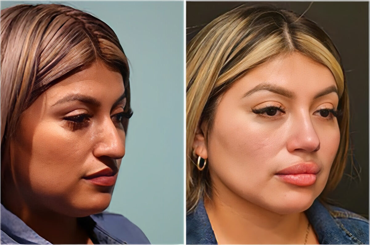 Before and after Rhinoplasty by Dr. Shervin Naderi, Patient 36861