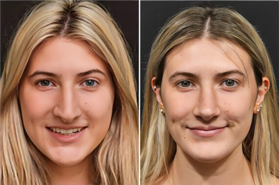 Before and after Rhinoplasty by Dr. Shervin Naderi, Patient 36884