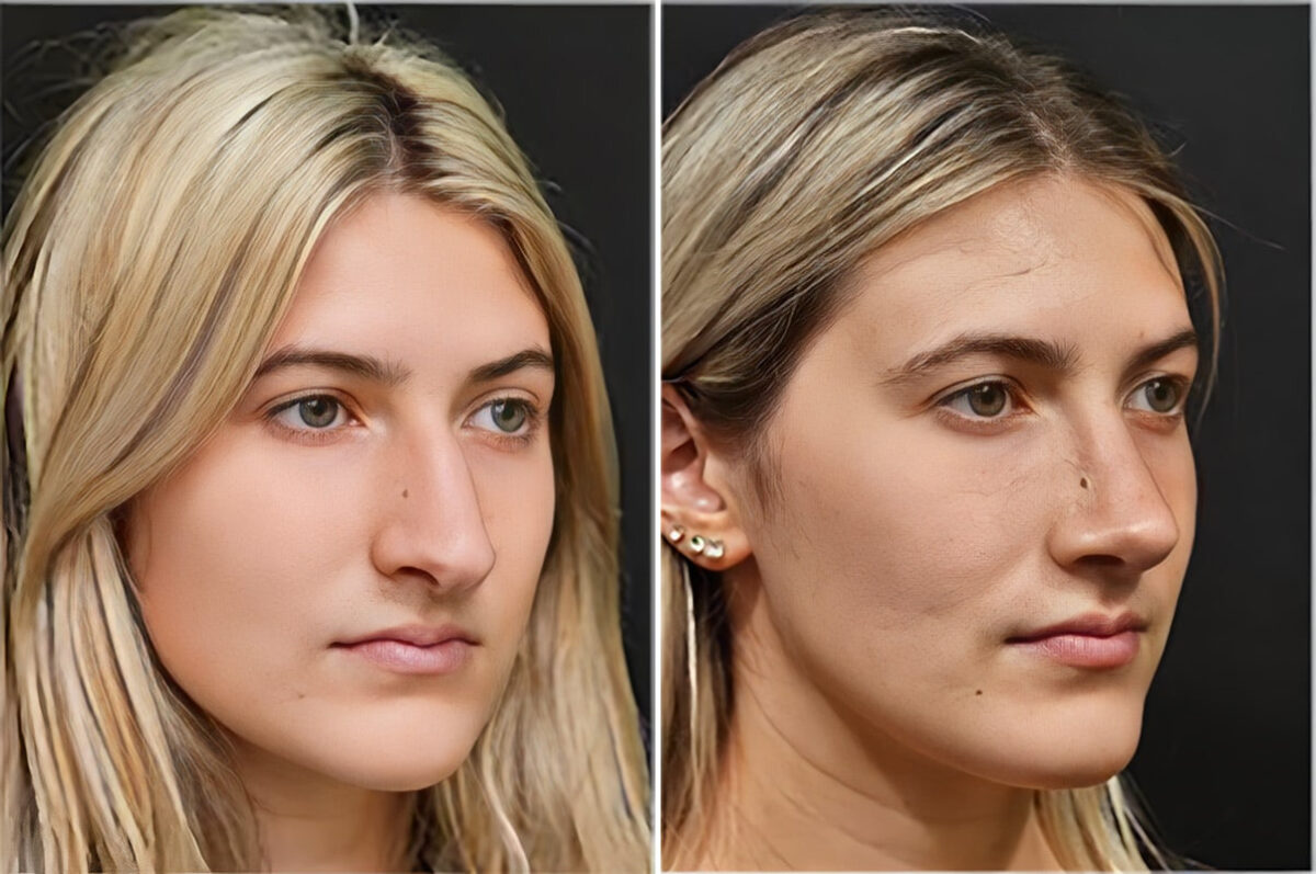 Before and after Rhinoplasty by Dr. Shervin Naderi, Patient 36884