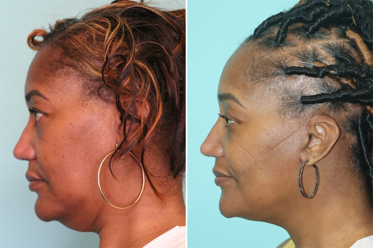 Before and after Facelift by Dr. Shervin Naderi, Patient 36969