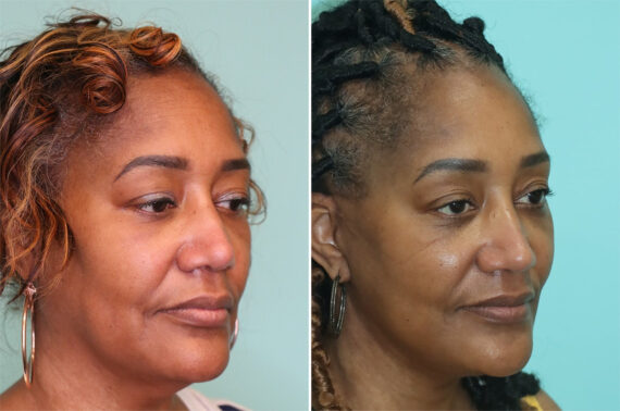 Before and after Facelift by Dr. Shervin Naderi, Patient 36969