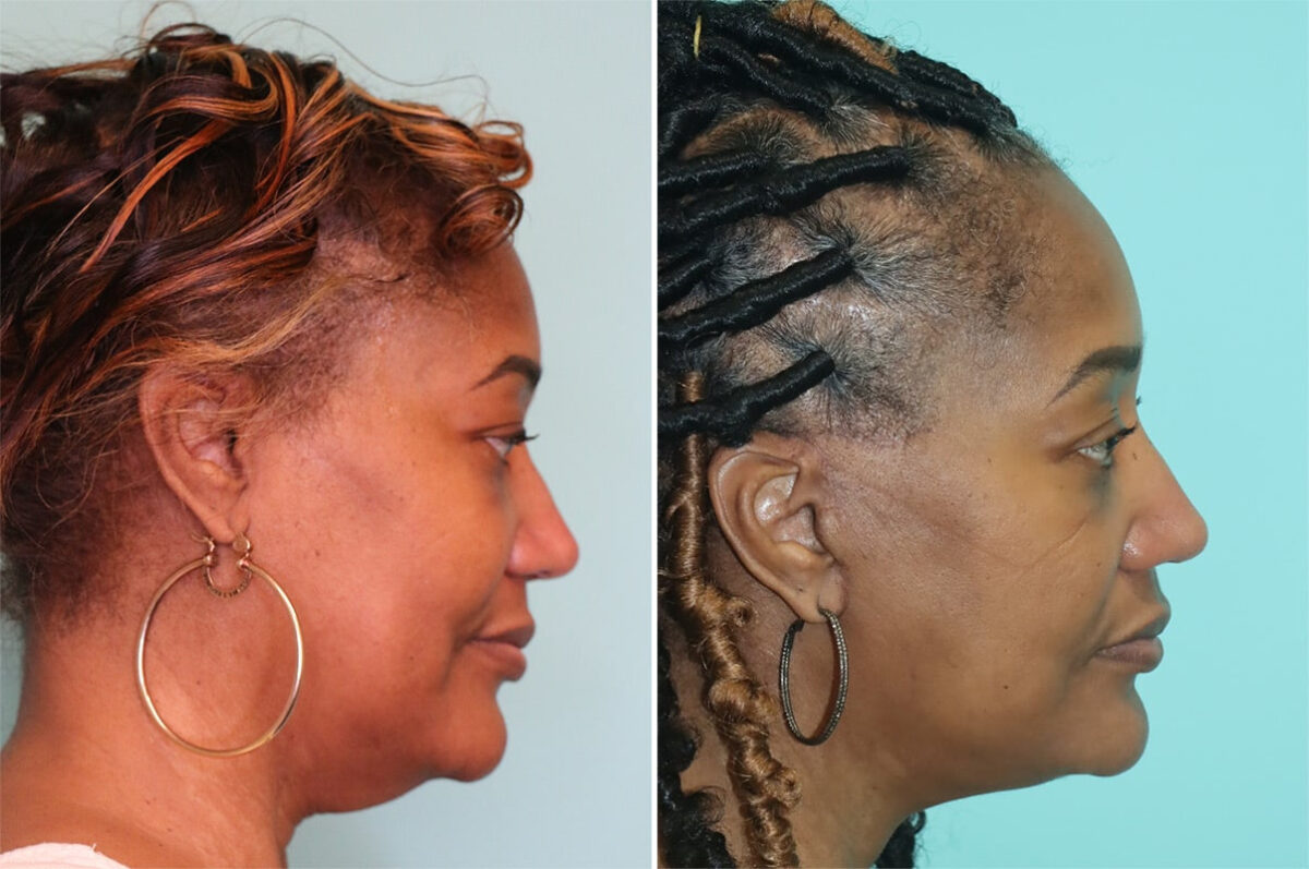 Before and after Facelift by Dr. Shervin Naderi, Patient 36969