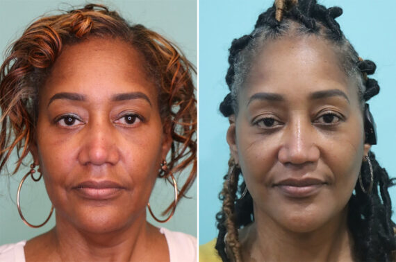 Before and after Facelift by Dr. Shervin Naderi, Patient 36969