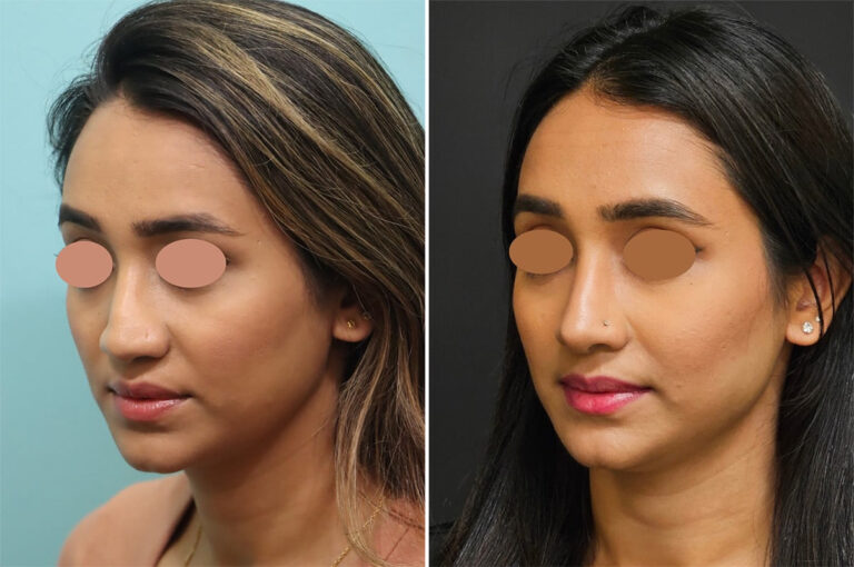 Before and after revision rhinoplasty by Dr. Shervin Naderi: rebuilt with rib cartilage