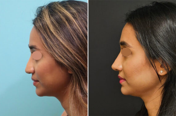 Before and after Revision Rhinoplasty by Dr. Shervin Naderi, Patient 36987