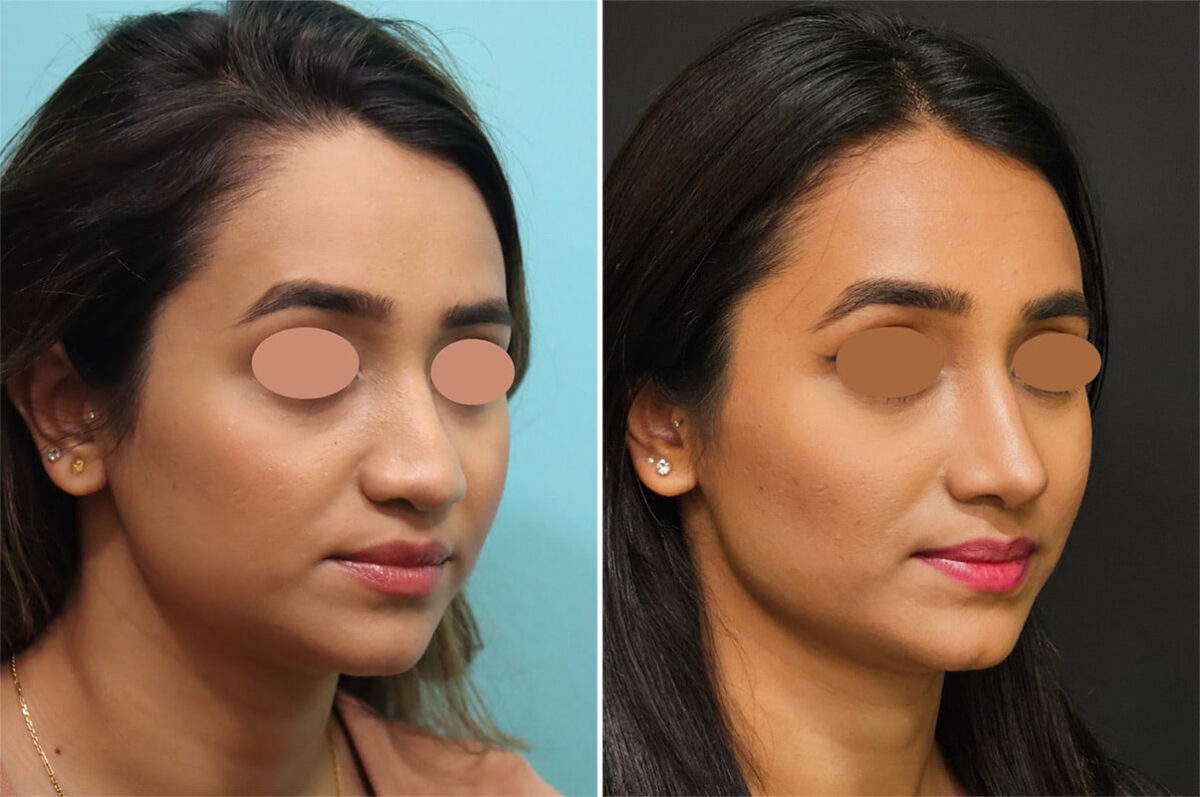 Before and after Revision Rhinoplasty by Dr. Shervin Naderi, Patient 36987