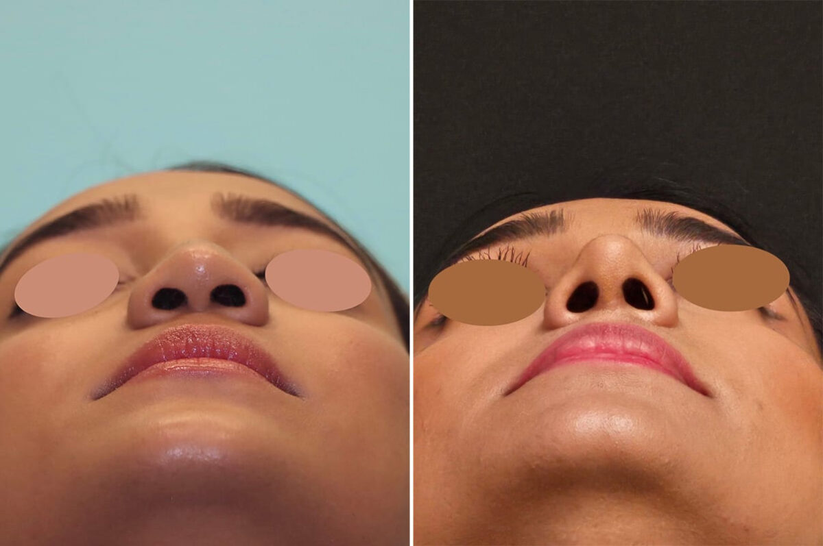 Before and after Revision Rhinoplasty by Dr. Shervin Naderi, Patient 36987