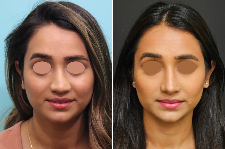 Before and after revision rhinoplasty by Dr. Shervin Naderi, front view