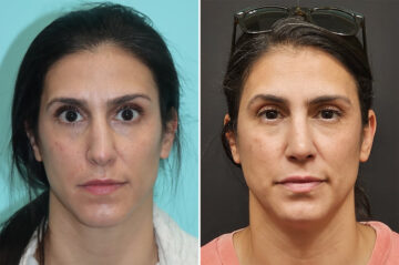 Before and after Revision Rhinoplasty by Dr. Shervin Naderi, Patient 37006