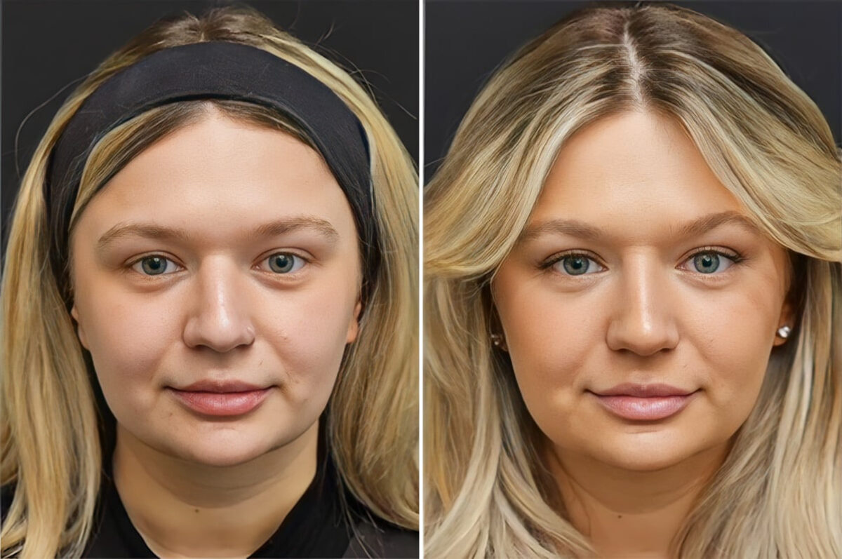 Before and after Non-Surgical Rhinoplasty by Dr. Shervin Naderi, Patient 37028