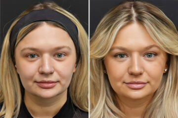 Before and after Non-Surgical Rhinoplasty by Dr. Shervin Naderi, Patient 37028