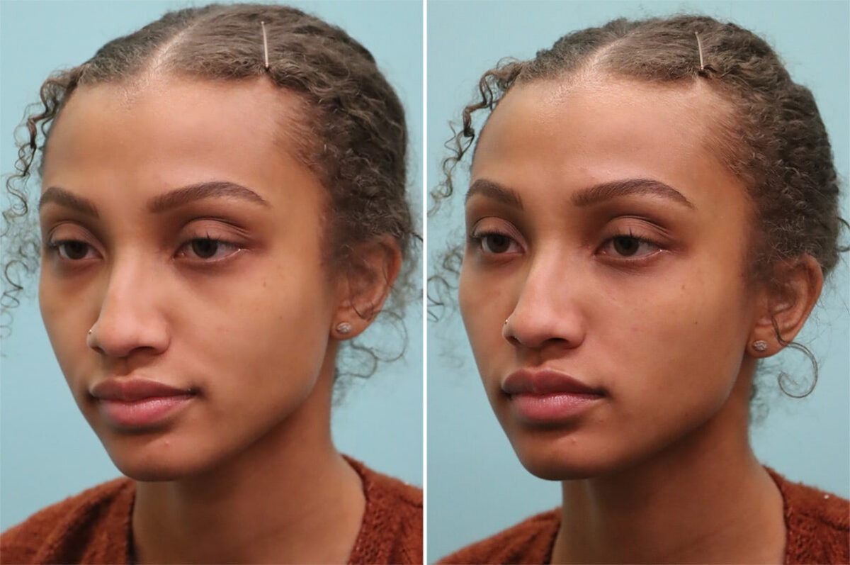 Before and after Tear Trough / Under Eye Injections by Dr. Shervin Naderi, Patient 37068