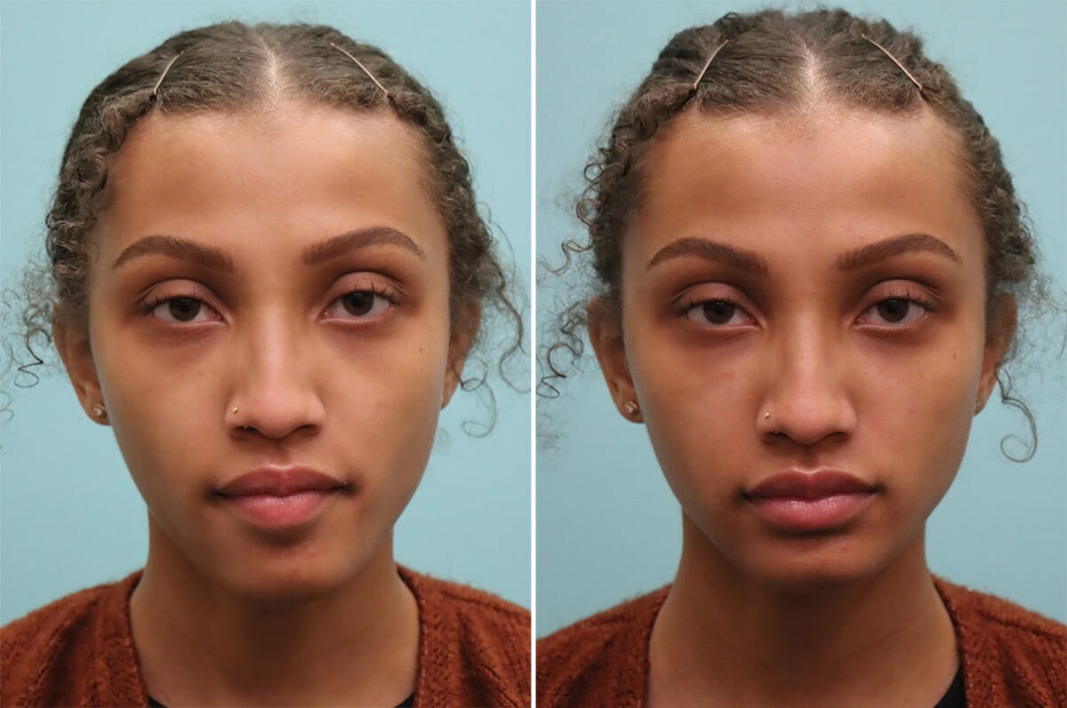 Before and after Tear Trough / Under Eye Injections by Dr. Shervin Naderi, Patient 37068