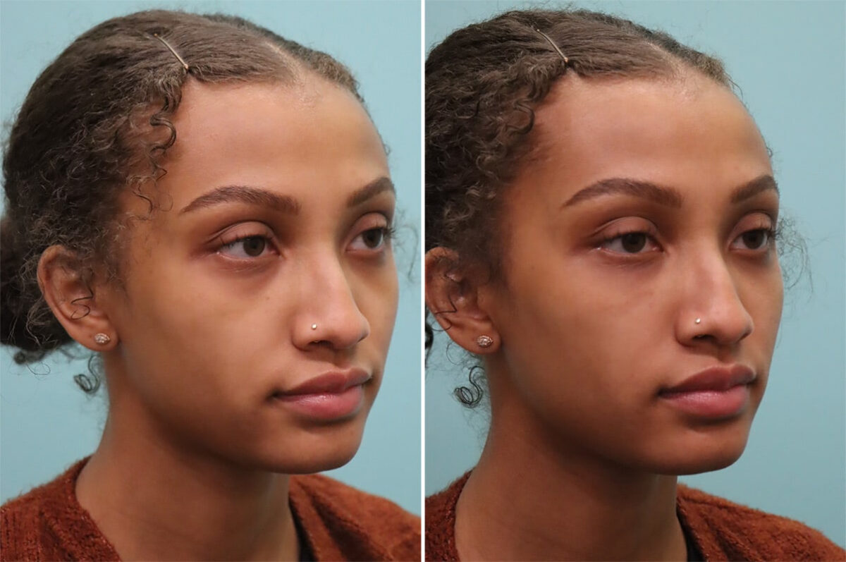 Before and after Tear Trough / Under Eye Injections by Dr. Shervin Naderi, Patient 37068