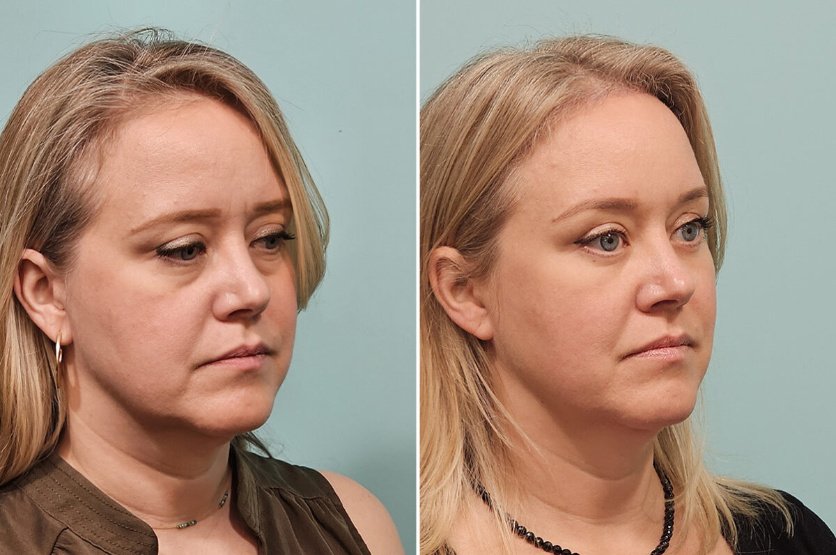 Before and after Brow Lift by Dr. Shervin Naderi, Patient 46751