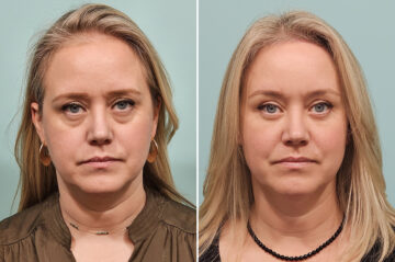 Before and after Brow Lift by Dr. Shervin Naderi, Patient 46751