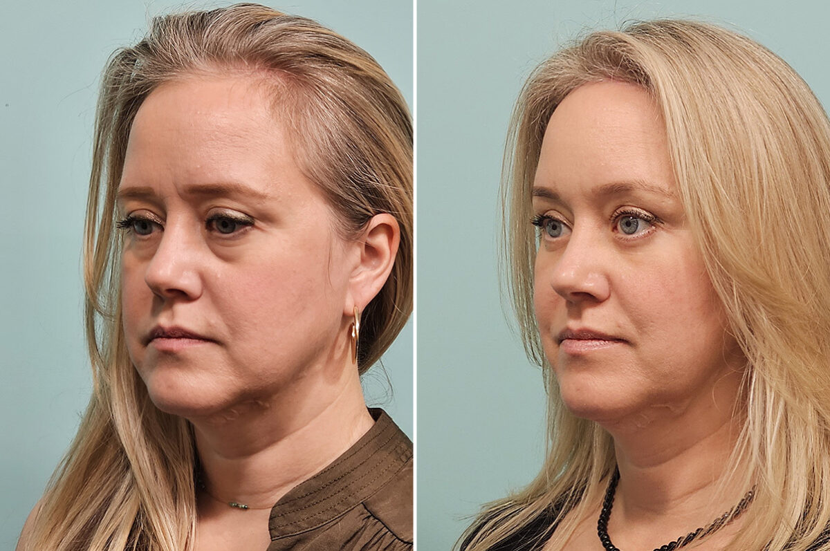 Before and after Fat Transfer by Dr. Shervin Naderi, Patient 46763