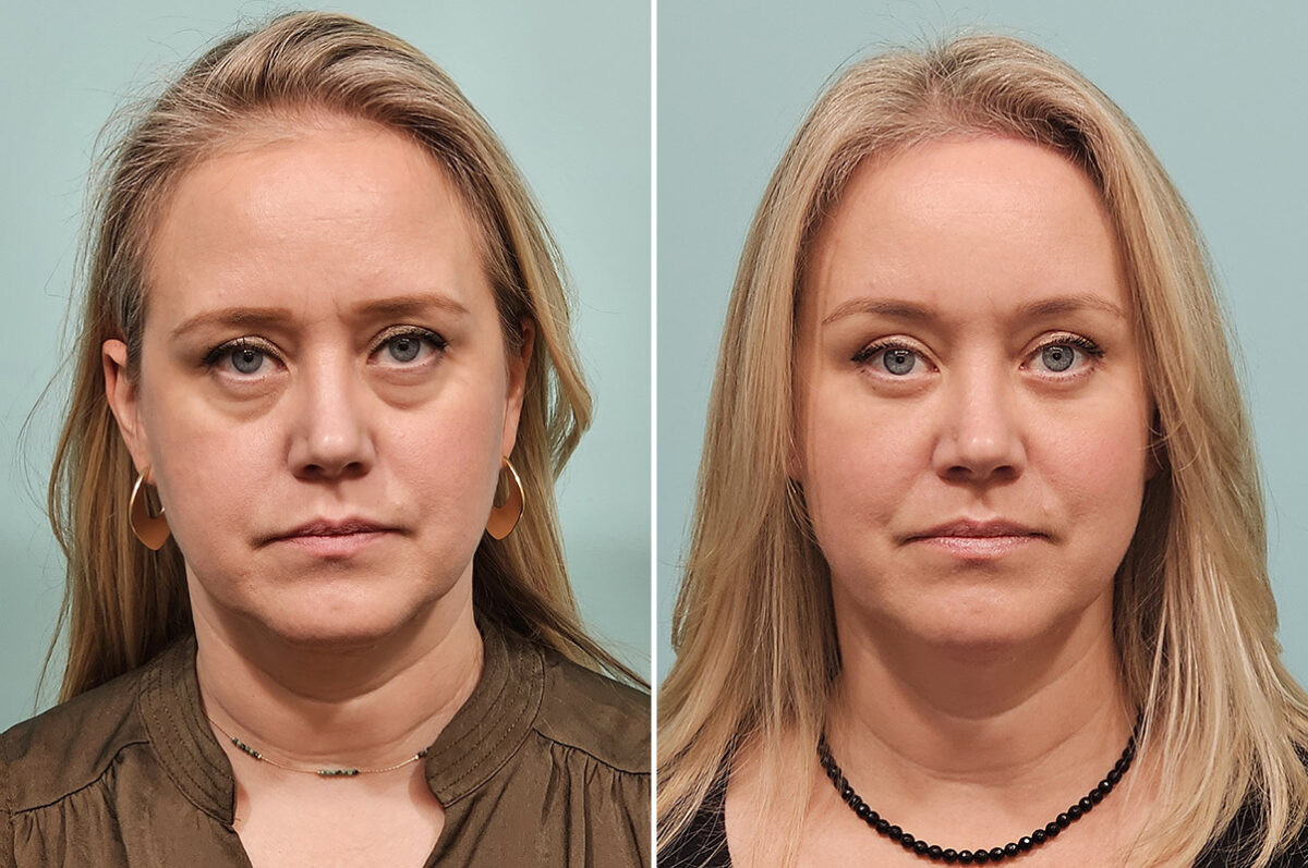 Before and after Fat Transfer by Dr. Shervin Naderi, Patient 46763