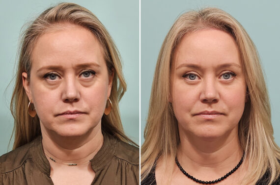 Before and after Fat Transfer by Dr. Shervin Naderi, Patient 46763
