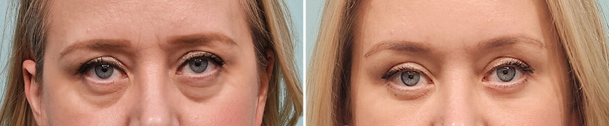 Before and after Blepharoplasty by Dr. Shervin Naderi, Patient 46767