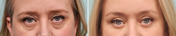 Before and after Blepharoplasty by Dr. Shervin Naderi, Patient 46767