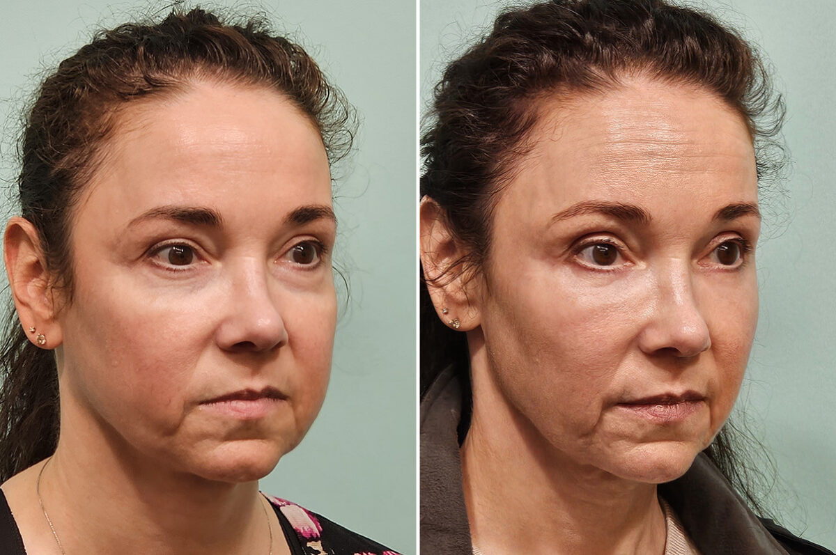 Before and after Blepharoplasty by Dr. Shervin Naderi, Patient 46770
