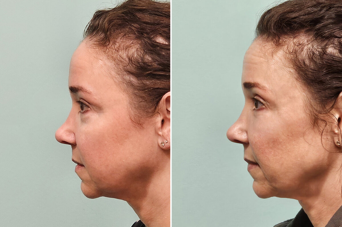 Before and after Blepharoplasty by Dr. Shervin Naderi, Patient 46770