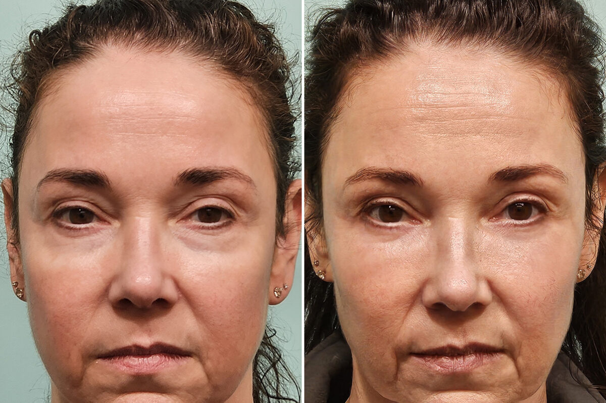 Before and after Blepharoplasty by Dr. Shervin Naderi, Patient 46770