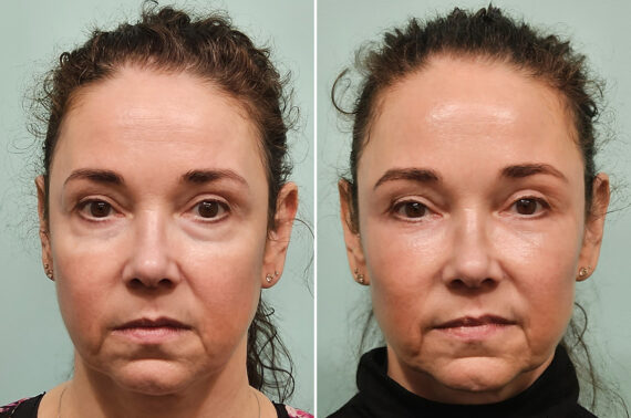 Before and after Blepharoplasty by Dr. Shervin Naderi, Patient 46770