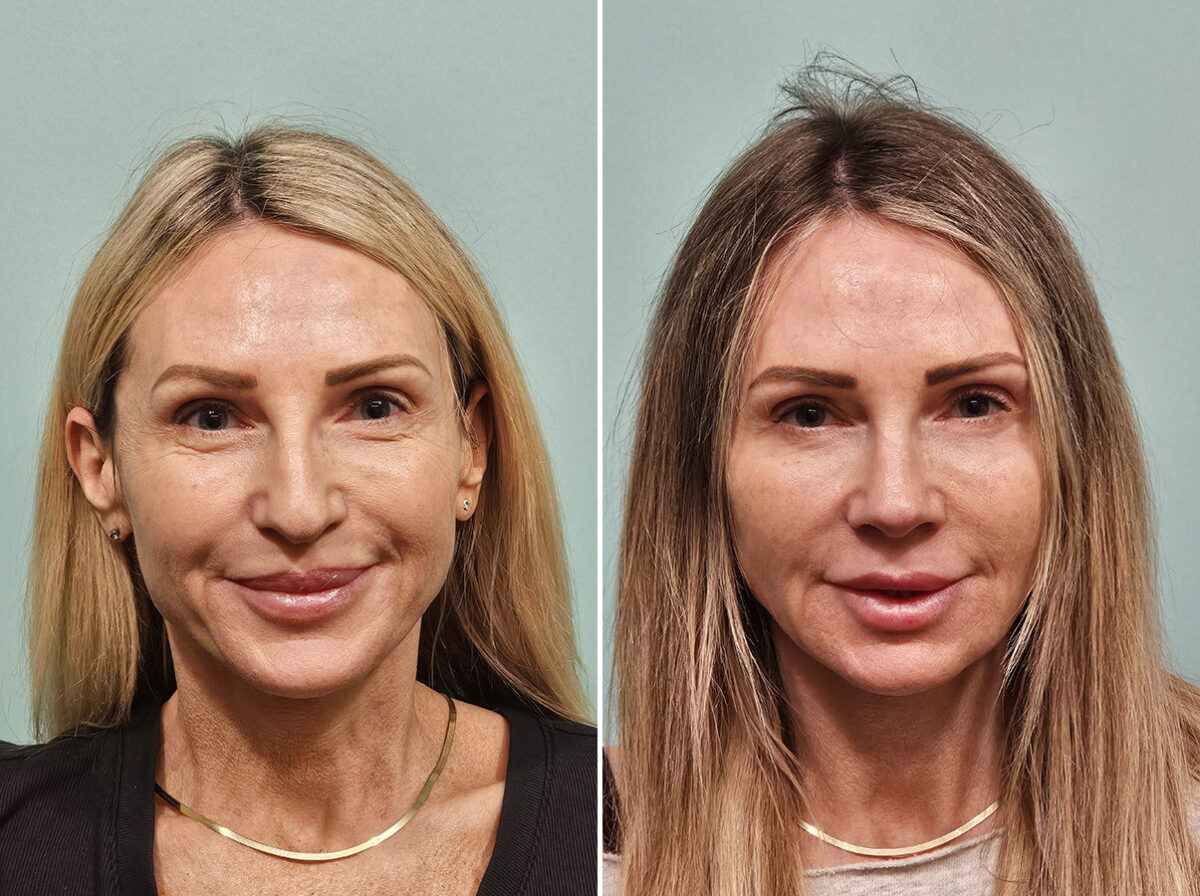 Before and after Rhinoplasty by Dr. Shervin Naderi, Patient 46901