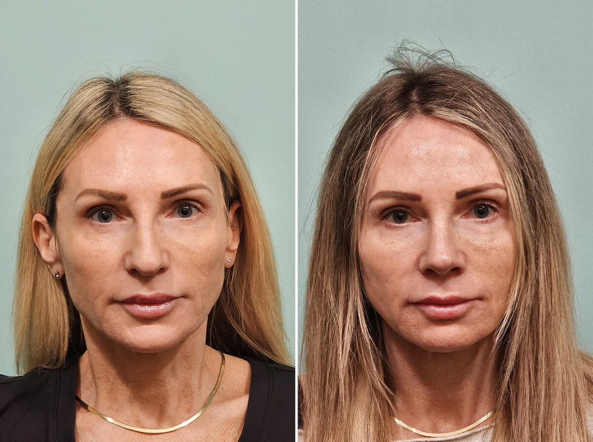 Before and after Rhinoplasty by Dr. Shervin Naderi, Patient 46901