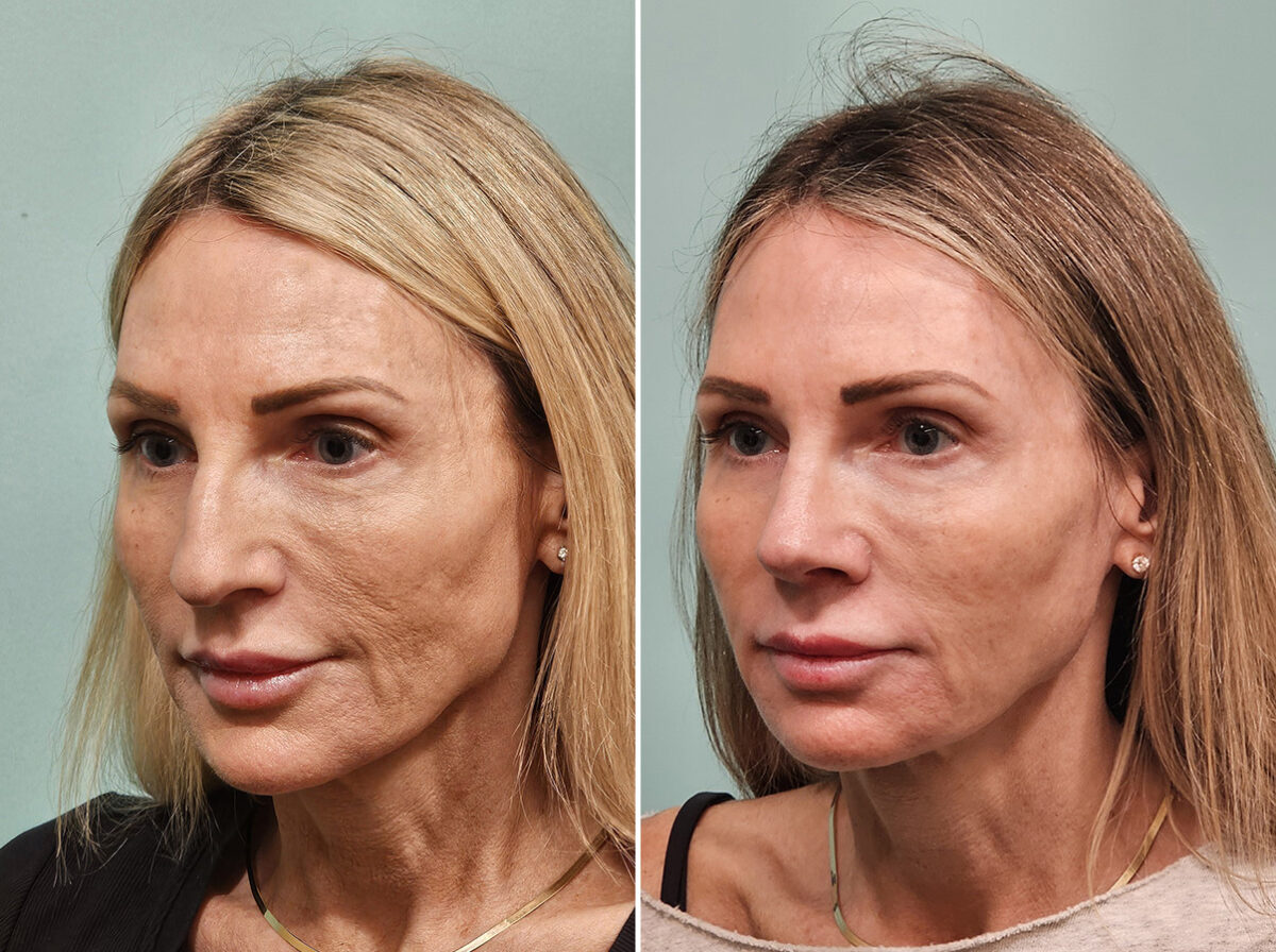 Before and after Rhinoplasty by Dr. Shervin Naderi, Patient 46901