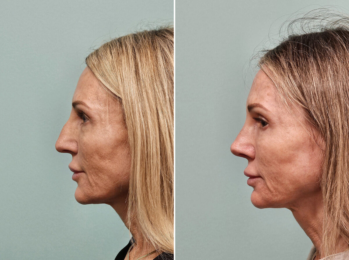 Before and after Rhinoplasty by Dr. Shervin Naderi, Patient 46901