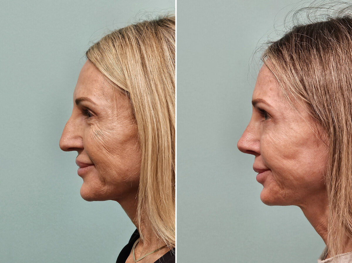 Before and after Rhinoplasty by Dr. Shervin Naderi, Patient 46901