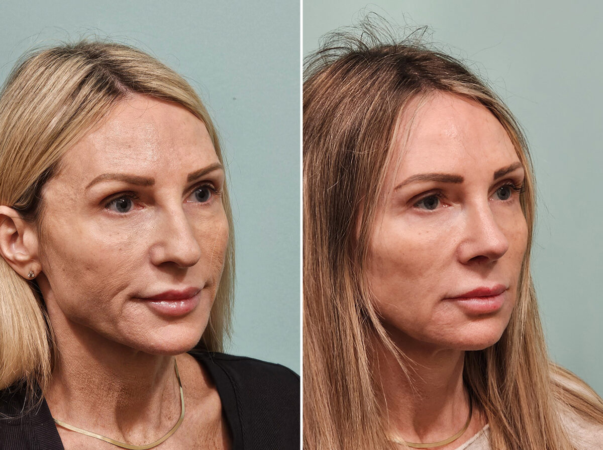 Before and after Rhinoplasty by Dr. Shervin Naderi, Patient 46901
