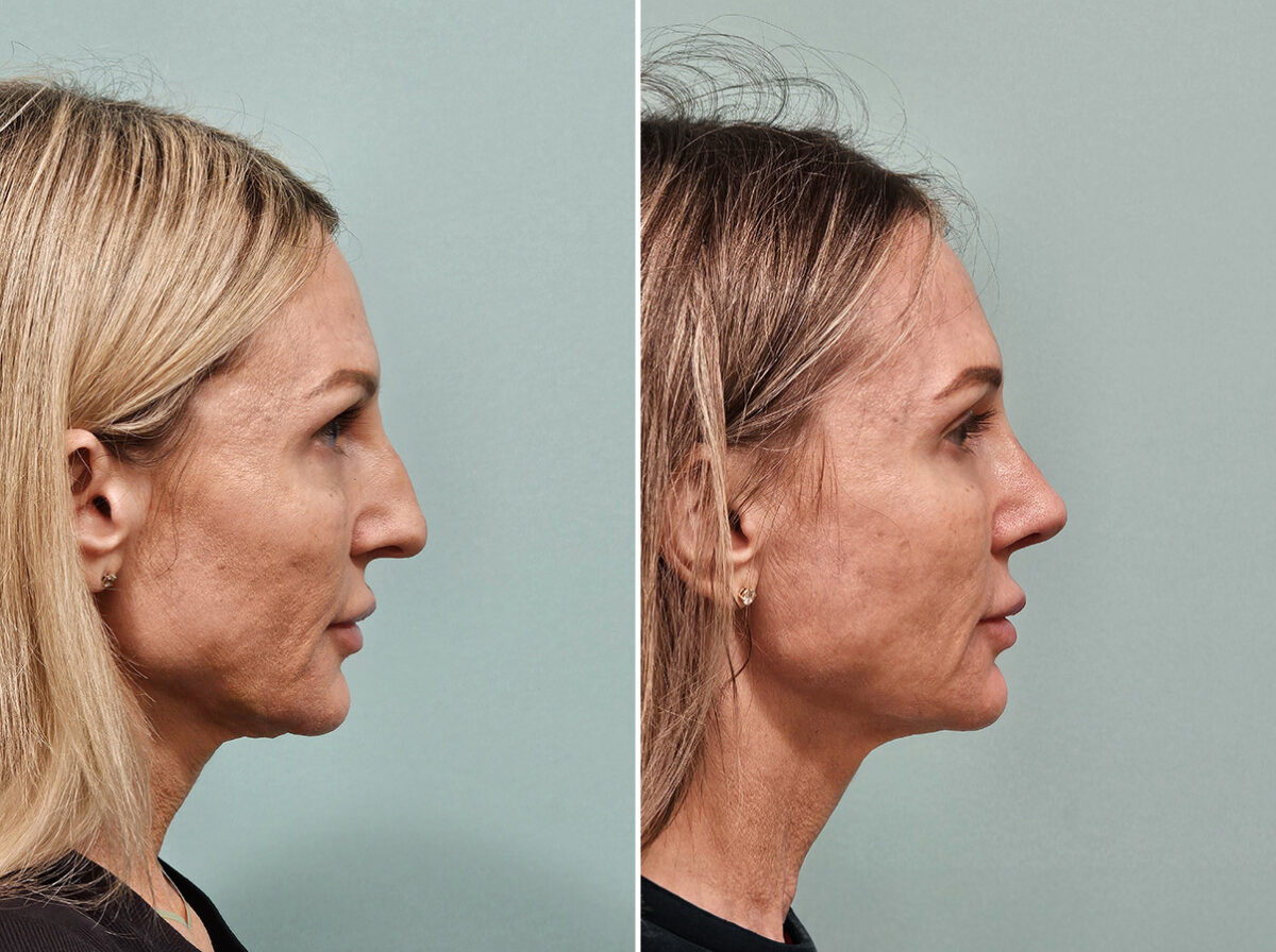 Before and after Rhinoplasty by Dr. Shervin Naderi, Patient 46901
