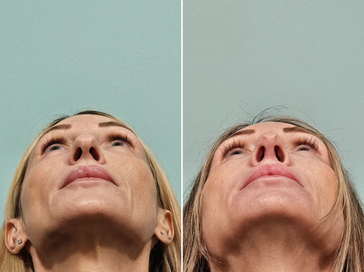Before and after Rhinoplasty by Dr. Shervin Naderi, Patient 46901