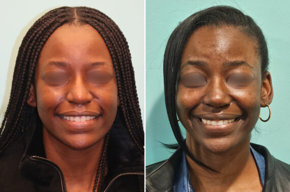 Before and after Revision Rhinoplasty by Dr. Shervin Naderi, Patient 46971