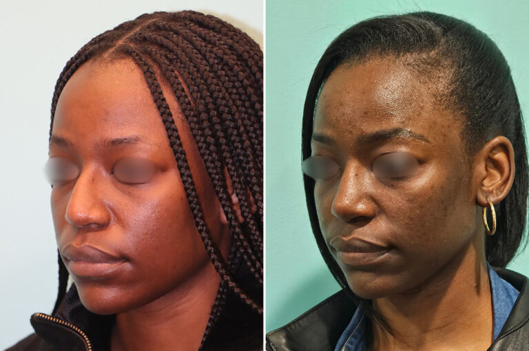 Before and after revision rhinoplasty by Dr. Shervin Naderi: still natural four years later