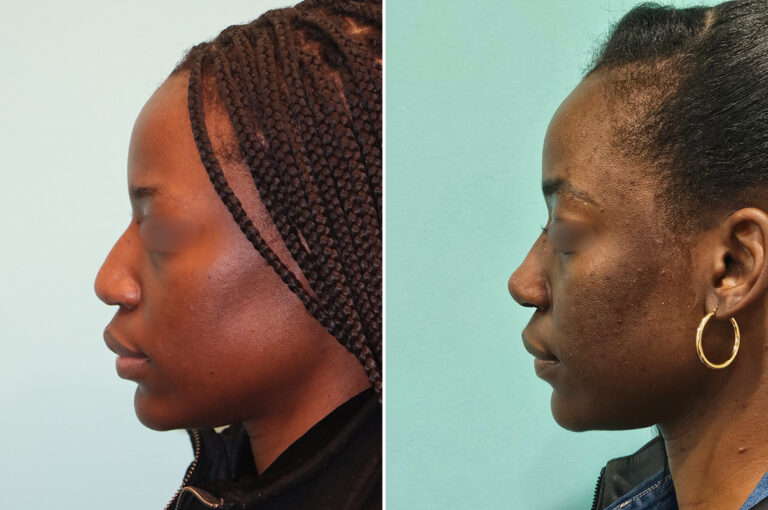 Before and after revision rhinoplasty by Dr. Shervin Naderi: still natural four years later