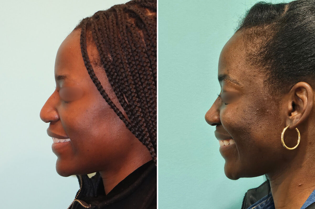Before and after Revision Rhinoplasty by Dr. Shervin Naderi, Patient 46971