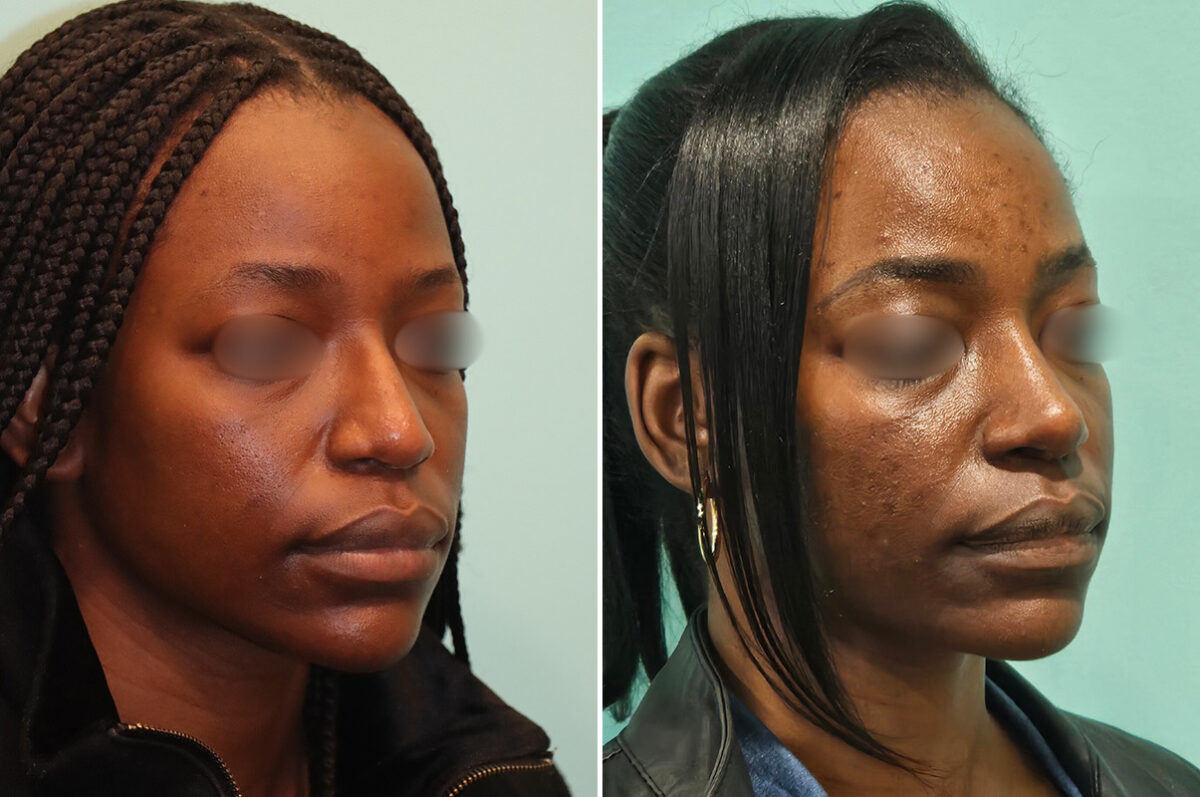 Before and after Revision Rhinoplasty by Dr. Shervin Naderi, Patient 46971