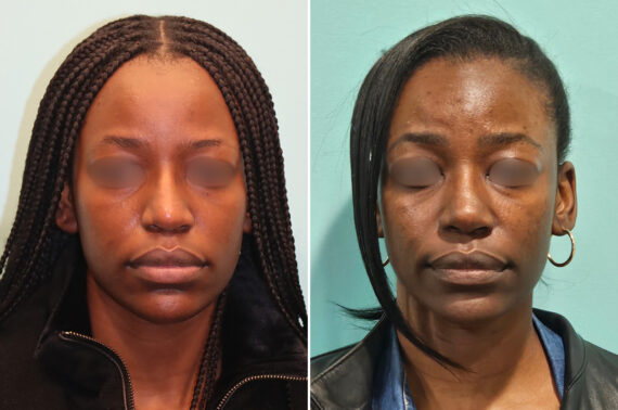 Before and after Revision Rhinoplasty by Dr. Shervin Naderi, Patient 46971